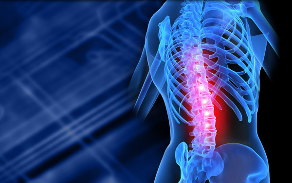 Spinal radiculopathies, Chronic Low back Pain