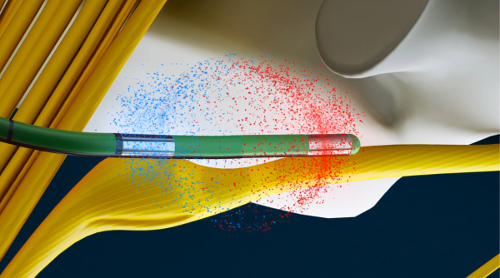 Ganglion Neurostimulation, Accustim-E, E-Cath, stimulation