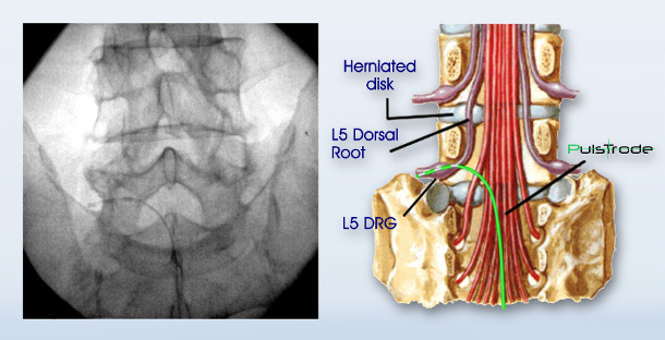 Spinal radiculopathies, Pulsed Radiofrequency