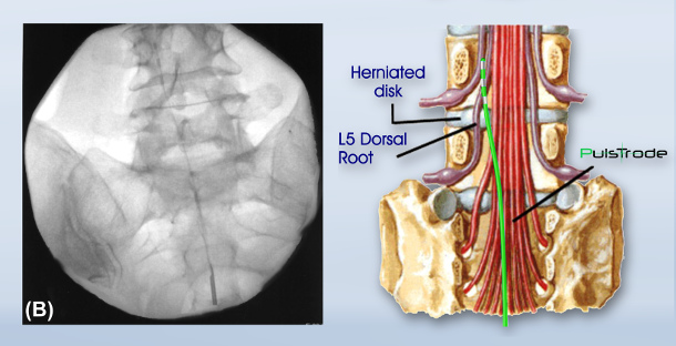 Spinal radiculopathies, Pulsed Radiofrequency