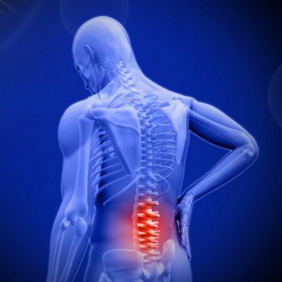 Spinal radiculopathies, Chronic Low back Pain